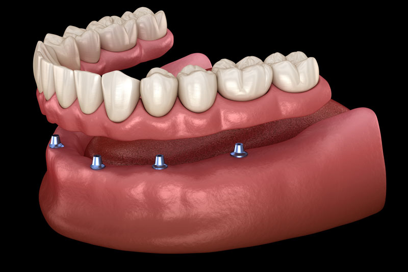 A 3D model showing implant-supported dentures in the lower jaw, with four metal implants acting as anchors for the denture, providing a secure fit for missing teeth.